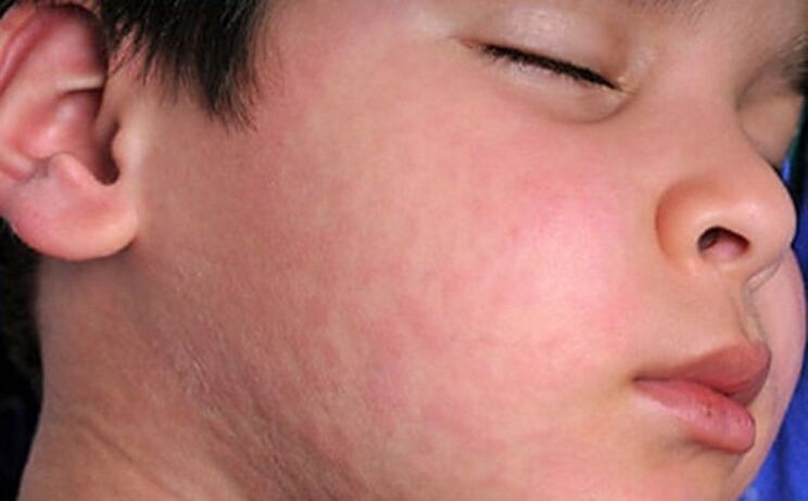 Eruzioni allergiche - un sintomo della presenza nel corpo di vermi parassiti