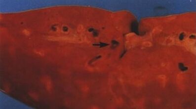 Quali parassiti possono vivere nel fegato umano